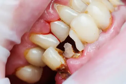 Denti con evidenti crepe e carie, gengive infiammate e sanguinanti. Un quadro preoccupante di salute orale.
