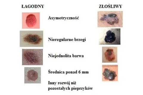 Kto bada pieprzyki? Dermatolog wyjaśnia, kiedy to konieczne i na co uważać