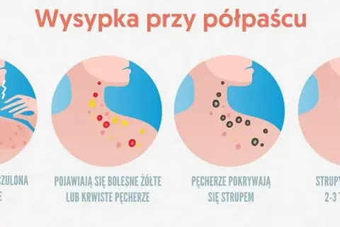 Półpasiec objawy u dziecka: Jak rozpoznać i uniknąć powikłań