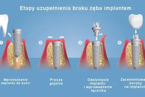 Jak wygląda implant zęba? Wszystko o budowie i procesie wszczepiania
