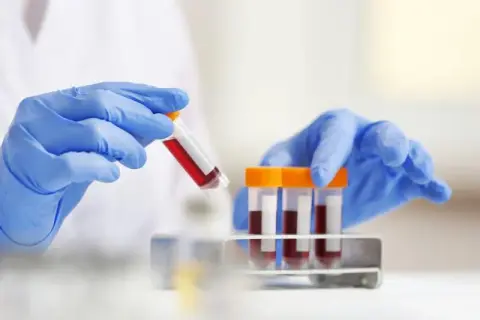 Co to jest ASO w badaniu krwi? Normy, interpretacja i znaczenie diagnostyczne