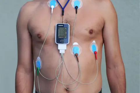 Czy Holter wykryje nerwicę? Ograniczenia badania EKG w diagnozie