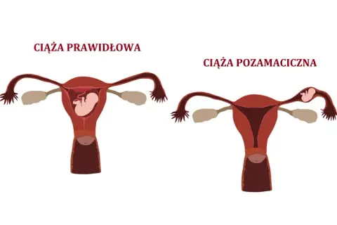 Ciąża pozamaciczna a test ciążowy - co musisz wiedzieć?
