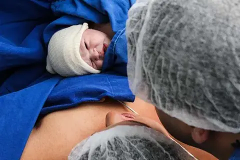 Czy cesarka to operacja? Poznaj prawdę o cesarskim cięciu