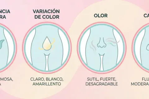 Ilustración de los tipos de flujo vaginal: consistencia, color, olor y cantidad. Se describen las variaciones normales y las que podrían indicar un problema.