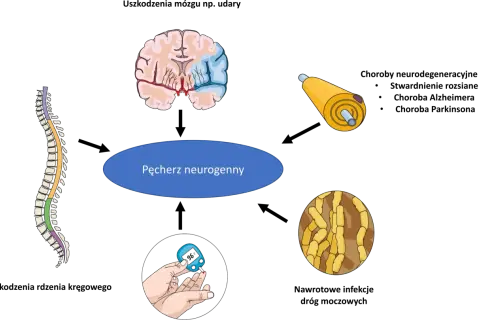 Ilustracja przedstawia przyczyny pęcherza neurogennego: mózg, rdzeń kręgowy, nerw, cukrzycę i bakterie. Czy pęcherz neurogenny da się wyleczyć?