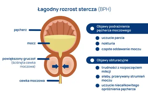 Ilustracja przedstawia łagodny rozrost stercza (BPH), powiększony gruczoł uciskający cewkę moczową, powodując objawy podrażnienia i obturacji.