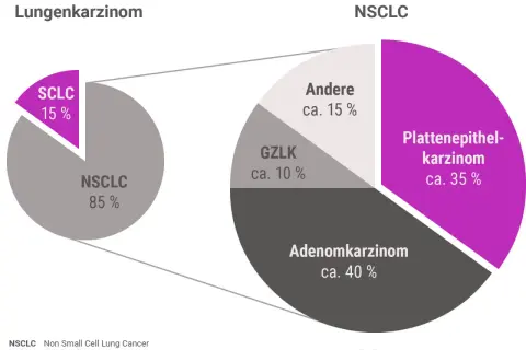 Diagramm zeigt Lungenkrebs-Arten: NSCLC (85%) und SCLC (15%). NSCLC unterteilt in Adenokarzinom (40%), Plattenepithelkarzinom (35%), GZLK (10%) und Andere (15%). Hoffnungsvolle lungenkrebs geheilt erfahrungsberichte sind hier relevant.