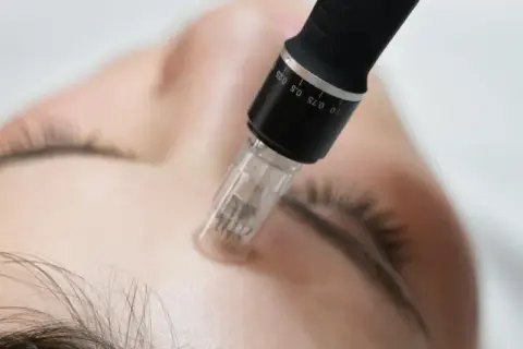 Un stylo de microneedling, utilisé pour un soin avec aiguille, effleure le front d'une personne.
