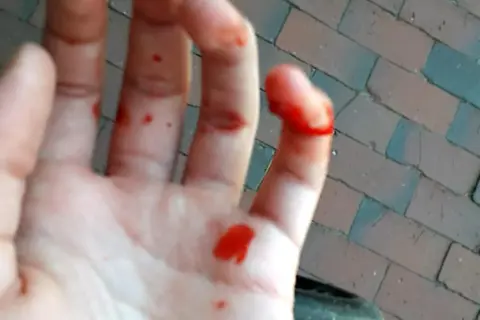 Blutige Hand mit einem offensichtlich gebrochenen Finger. Kleine Schnitte und Blutstropfen auf der Handfläche und den Fingern.