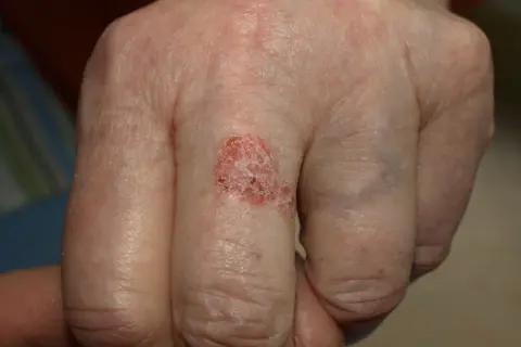 Hautveränderung am Finger, die an Morbus Bowen erinnert. Solche Hautstellen sind oft Thema in Erfahrungsberichten.