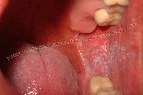 Lesione reticolare bianca sulla mucosa orale, tipica del lichen planus.