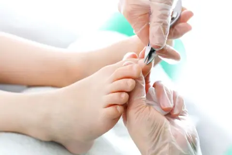 Pedicure: usuwanie skórek wokół paznokci u stóp, które mogą przypominać paznokcie rurkowate.