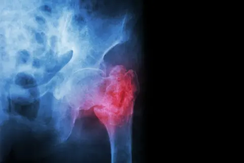 Radiographie du bassin montrant une fracture du col du fémur, marquée en rouge pour indiquer la douleur et la lésion.
