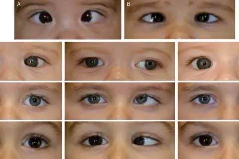 Primeros planos de ojos de bebés y niños pequeños, mostrando diferentes tipos de estrabismo en niños de 1 a 2 años.