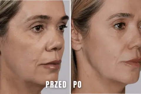 Porównanie skóry kobiety przed i po zabiegu kosmetycznym.