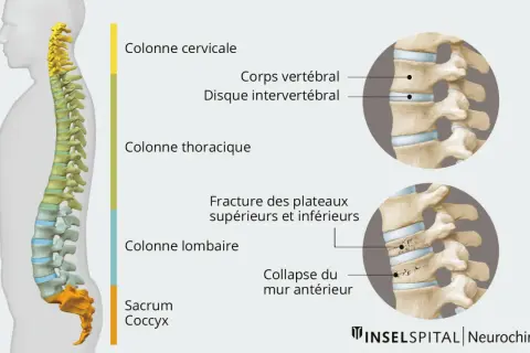 Illustration montrant une fracture vertèbre lombaire. Le temps de guérison dépend de la gravité de la lésion.