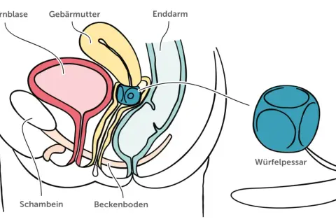 Schema des weiblichen Beckens mit Harnblase, Gebärmutter und Enddarm. Ein Würfelpessar wird gezeigt, dessen Nachteile hier nicht thematisiert werden.