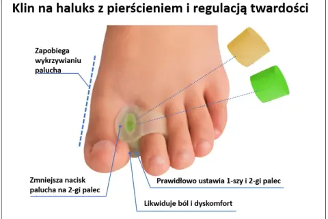 Haluks: Ból stóp? Jak rozpoznać i skutecznie leczyć paluch koślawy