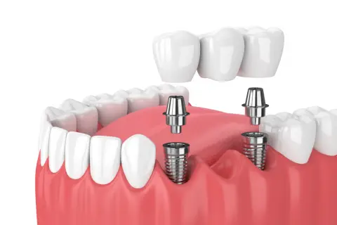 Model szczęki z widocznymi implantami zębowymi i mostem protetycznym. Implant zęba to nowoczesne rozwiązanie.