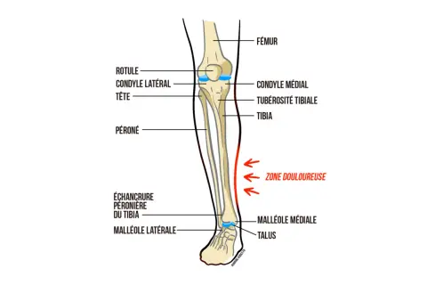 Anatomie du tibia avec une zone douloureuse marquée, typique de la douleur au tibia chez un débutant en course à pied.