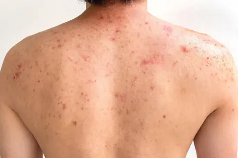 Espalda con numerosos granos y marcas de acné, mostrando rojeces e inflamación.