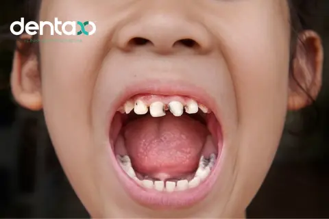Usta dziecka otwarte, ukazujące zniszczone, czarne zęby u dzieci. Widoczny znak wodny "dentaxo".