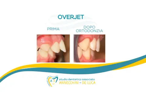 Prima e dopo ortodonzia: denti castoro corretti. Studio dentistico Annecchini - De Luca.