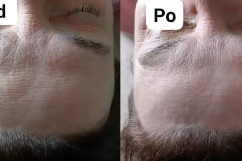 Przed i po zabiegu: zoga face wygładzona, zmarszczki na czole mniej widoczne.