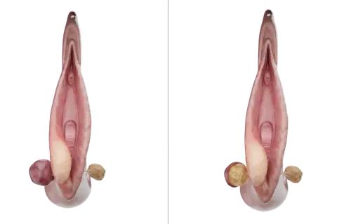 Anatomie féminine montrant une glande de Bartholin enflammée, illustration pour le bartholinite traitement.