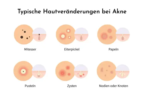 Illustration zeigt typische Hautveränderungen bei Akne: Mitesser, Eiterpickel, Papeln, Pusteln, Zysten und Knoten.
