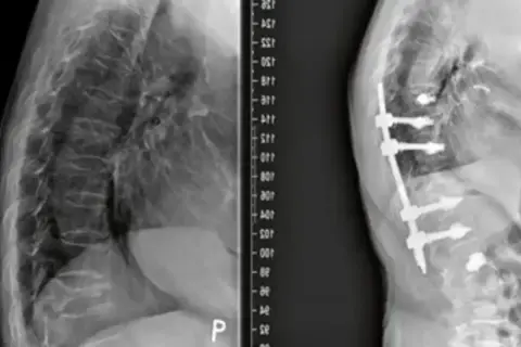 Rentgen kręgosłupa przed i po stabilizacji implantami.