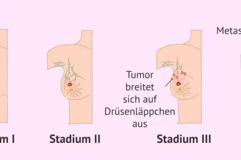 Illustrationen zeigen Stadien von Brustkrebs. Von Stadium I bis IV wächst der Tumor, befällt Lymphknoten und bildet Metastasen. Brustkrebs G3 Erfahrungen sind oft mit fortgeschrittenen Stadien verbunden.