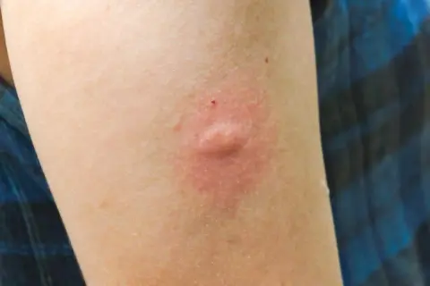 Brazo con una picadura hinchada y dura, rodeada de enrojecimiento.