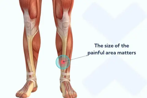 Anatomia della gamba con evidenziato il dolore tibiale anteriore camminare. L'area dolorante è indicata da cerchi concentrici.