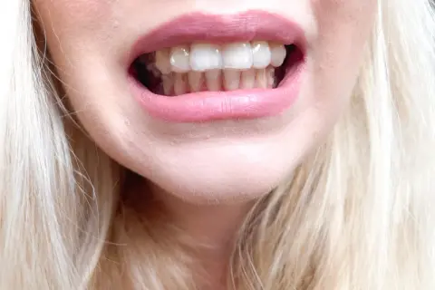 Uśmiech z dyskretnymi nakładkami Invisalign, które korygują zęby. Jasne włosy i różowe usta dopełniają całość.