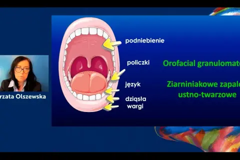 Ilustracja jamy ustnej z zaznaczonymi podniebieniem, policzkami, językiem i dziąsłami. Obok tekst: Orofacial granulomatosis, Ziarniniakowe zapalenie ustno-twarzowe.