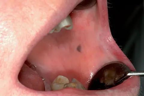 Piccolo neo scuro, una lesione mucosa geniena, visibile all'interno della bocca, vicino ai denti.