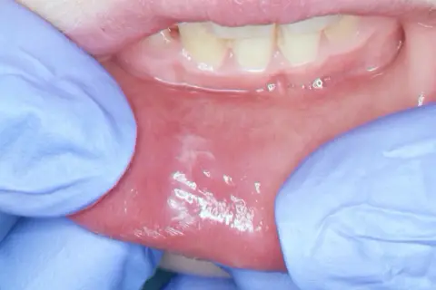 Dita guantate espongono la mucosa orale, rivelando una macchia bianca sul labbro inferiore, forse un segno di irritazione.