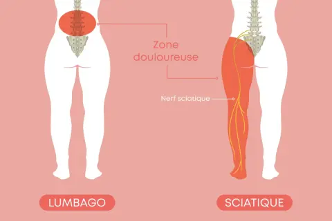 Illustration montrant la différence entre le lumbago et la sciatique, avec le nerf sciatique et la zone douloureuse.