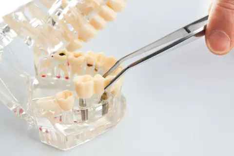 Model szczęki z implantami zębów, gdzie pęseta manipuluje ruszającym się implantem zęba, pokazując jego stabilność.
