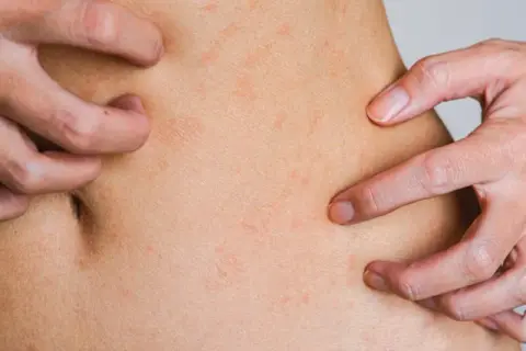 Zaburzenia hormonalne objawy skórne: co może oznaczać Twoja skóra?
