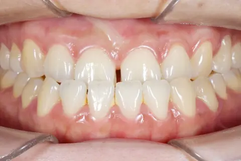Denti superiori e inferiori di un adulto con un evidente morso incrociato. Si nota uno spazio tra gli incisivi superiori.