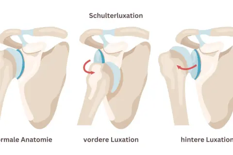 Schulterluxation: normale Anatomie, vordere Luxation (Rotationspfeil) und hintere Luxation (Rotationspfeil). Eine latarjet op kann bei wiederholten Luxationen helfen.