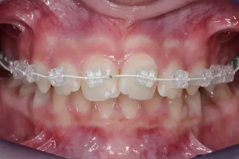Primo piano di denti con apparecchio trasparente. Il filo bianco collega i bracket, mostrando il progresso del trattamento ortodontico e suggerendo ogni quanto si cambia il filo dell'apparecchio.