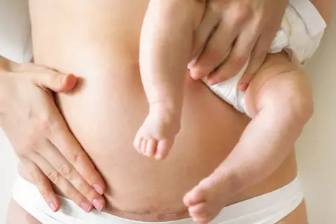 Blizna po cesarskim cięciu na brzuchu mamy, która tuli swoje dziecko. Krocze po porodzie jest w pełni widoczne.