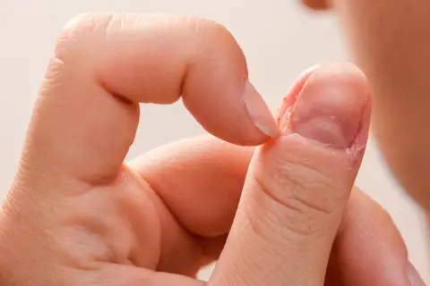 Zbliżenie na palec z widocznymi oznakami chorób paznokci, takich jak łuszczenie się skóry wokół paznokcia i jego nierówna powierzchnia.