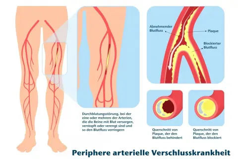 Illustration zeigt PAVK: Plaque verengt Arterien im Bein, behindert Blutfluss. Gehtraining kann helfen.