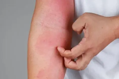 Alergia na leki objawy – jak rozpoznać groźne reakcje alergiczne