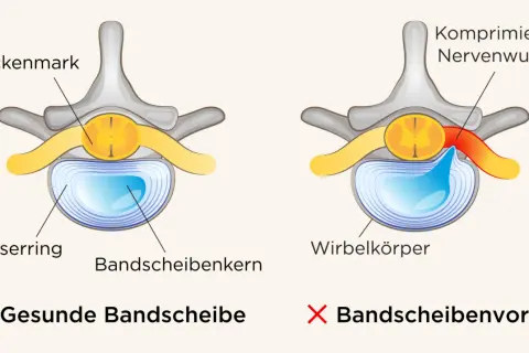 Vergleich einer gesunden Bandscheibe mit einem Bandscheibenvorfall, der eine Nervenwurzel komprimiert und so Symptome verursacht.